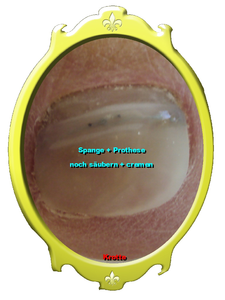 Fußpflege pilz,spange+ Prothese DSC02597